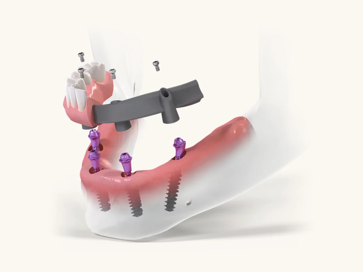 All-on-4 full-arch fixed bridge on implants at GC Clinic Istanbul