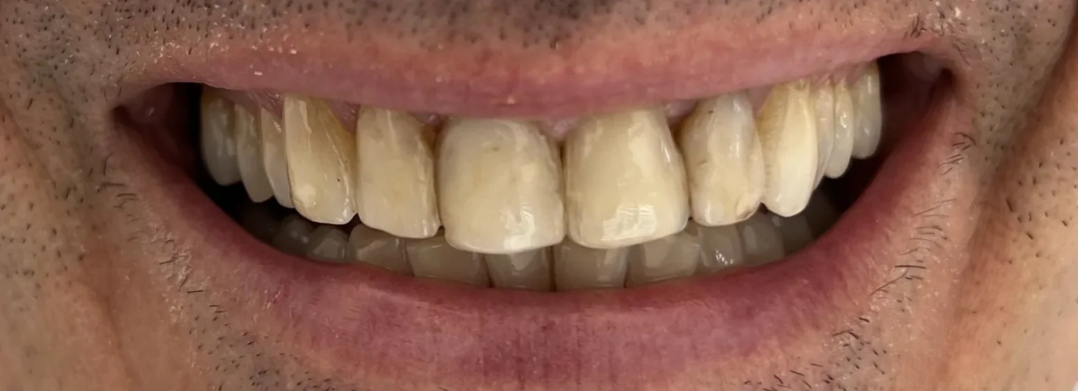 Before: minimally invasive e.max veneers — real GC Clinic case