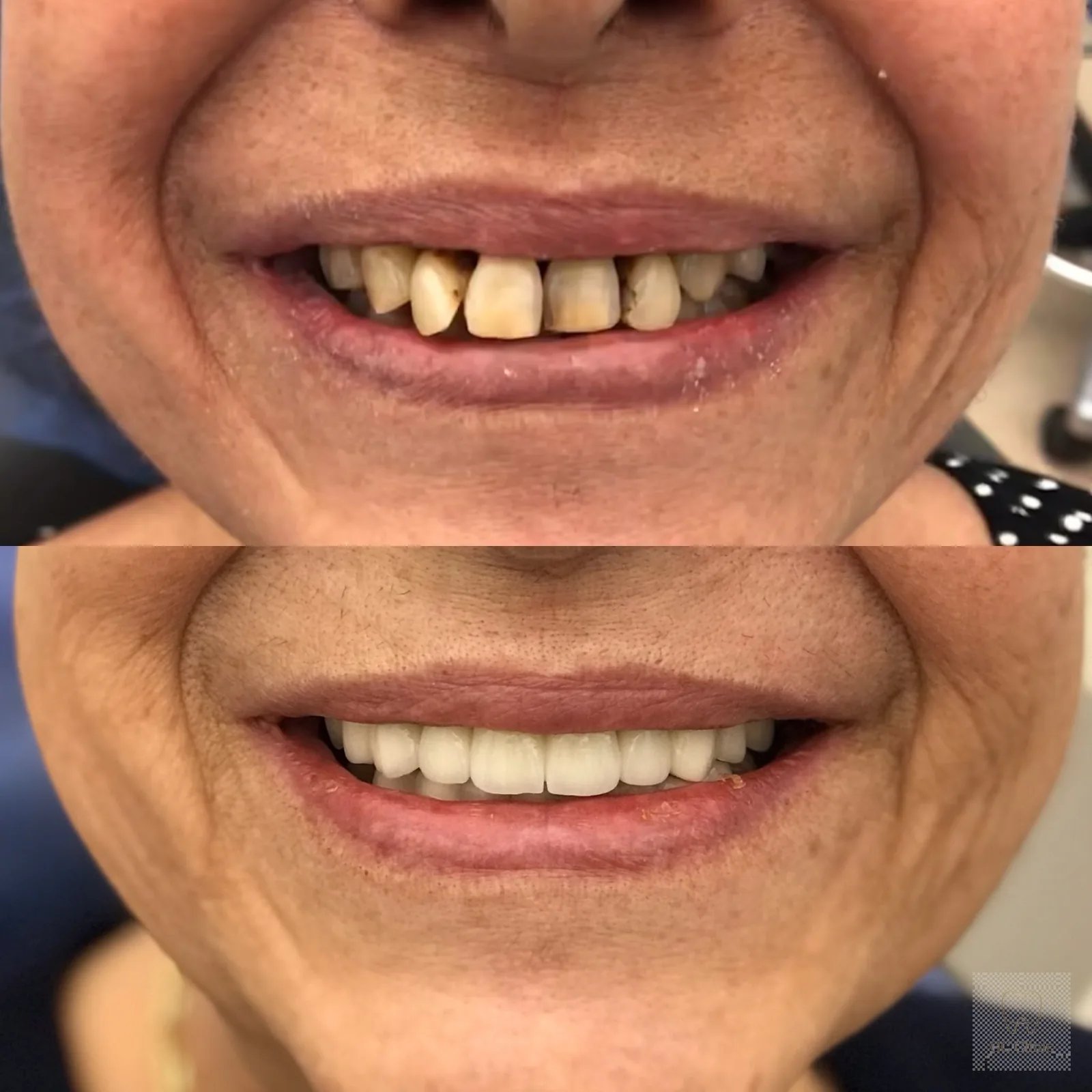 gum treatment at GC Clinic Istanbul