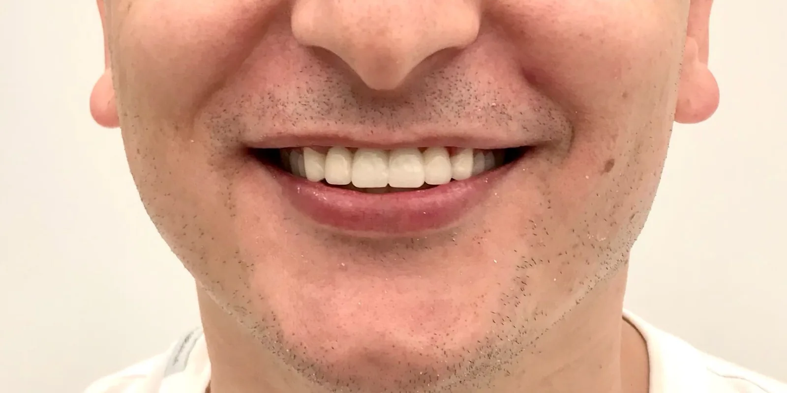 After: Facially Driven Smile Design (Turkey Teeth Recovery)