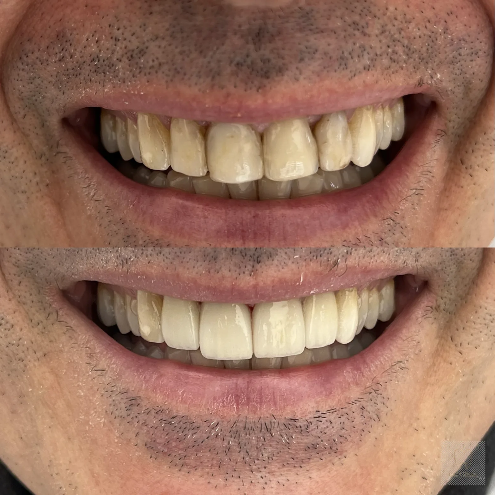 Before and after minimally invasive smile enhancement at GC Clinic Istanbul — a patient's four upper front teeth with aged, discoloured composite fillings refre