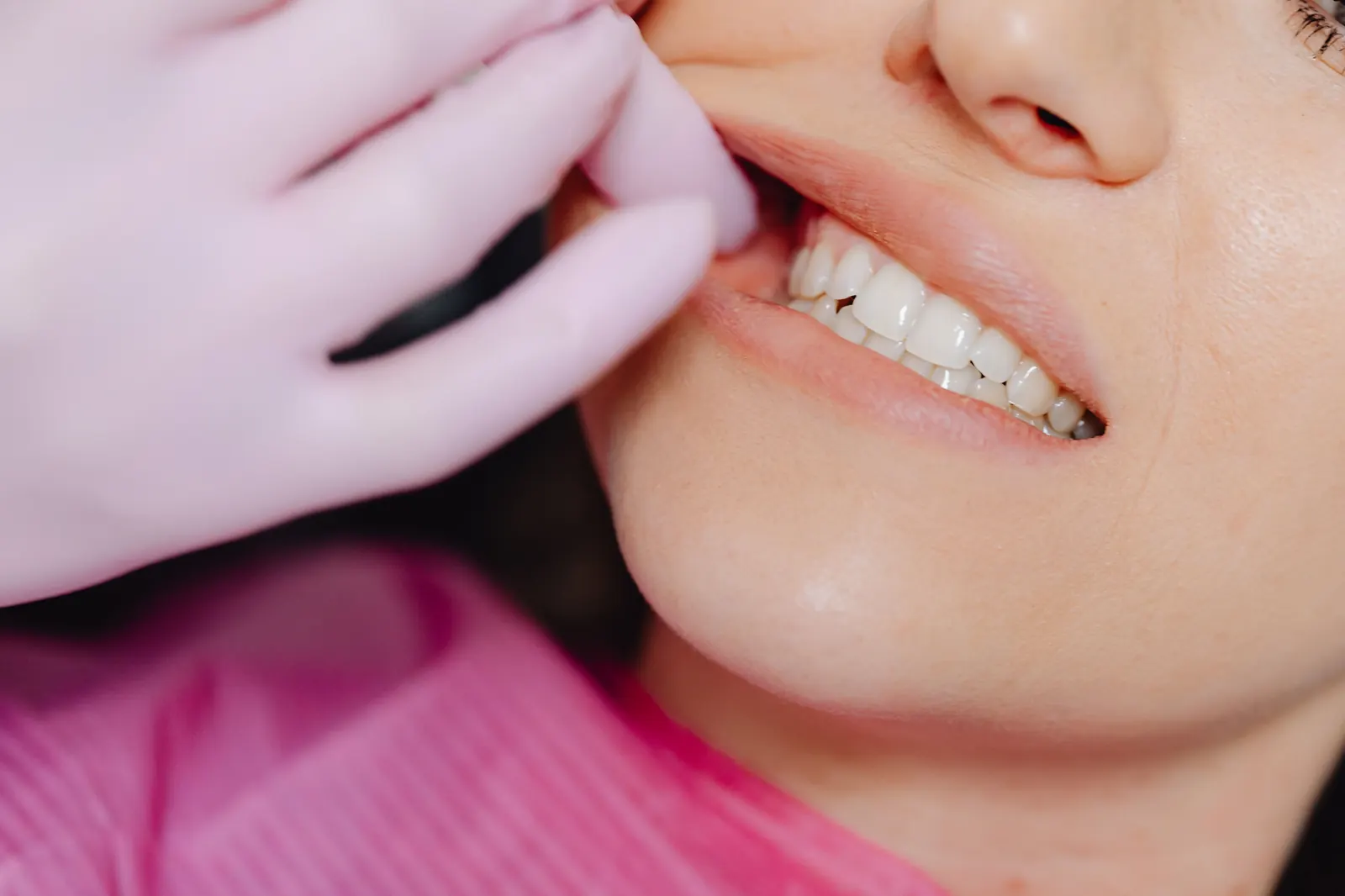 No-prep veneers in Turkey: ultra-thin e.max veneer with no tooth shaving — GC Clinic Istanbul