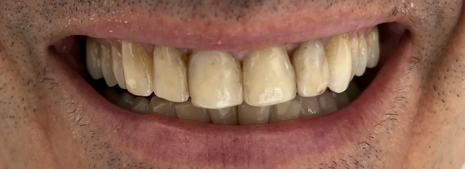 Before: Minimal Invasive Smile Enhancement