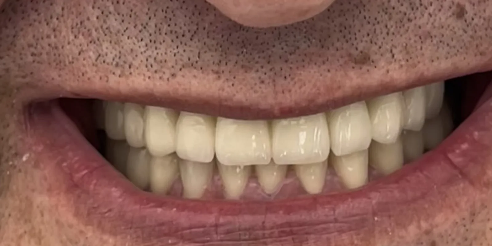 After: Functional Full-Mouth Rehabilitation