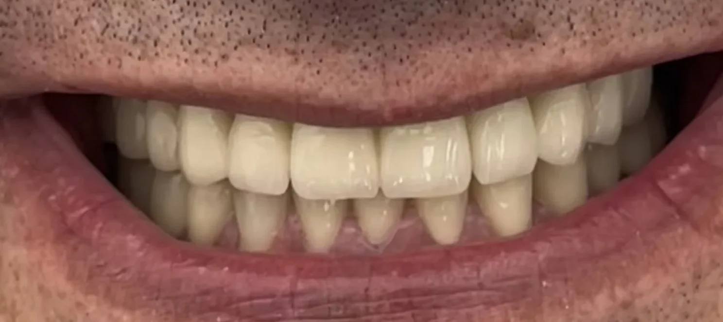 After: Functional Full-Mouth Rehabilitation