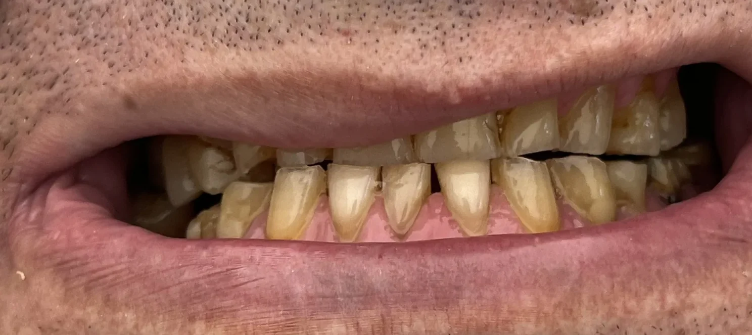 Before: Functional Full-Mouth Rehabilitation
