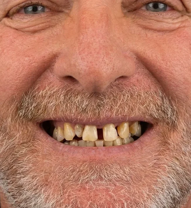 Before: Full-Mouth Rehabilitation