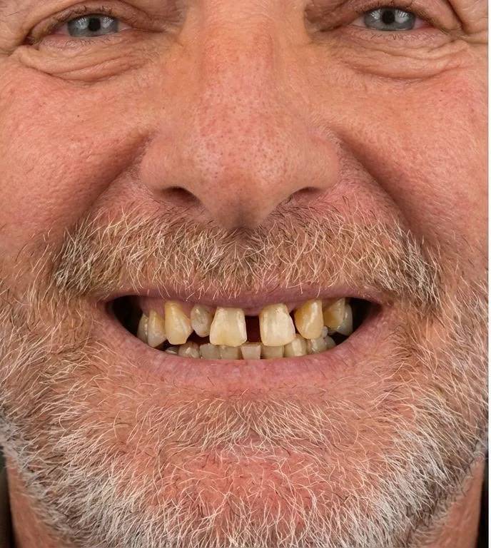 Before: Full-Mouth Rehabilitation
