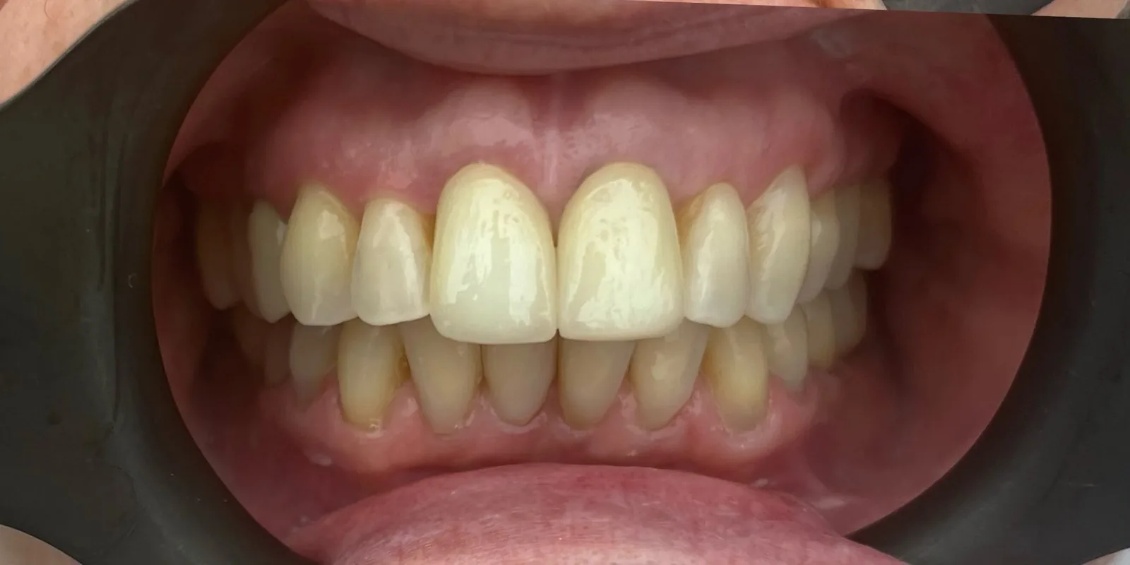 After: Bridge Renewal & Composite Bonding