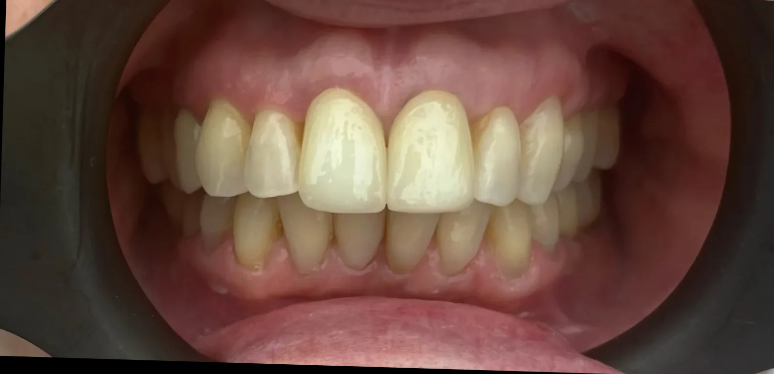 After: Bridge Renewal & Composite Bonding