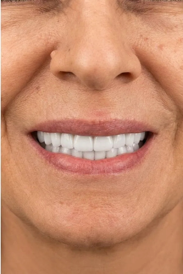 After: Full-Mouth Rehabilitation