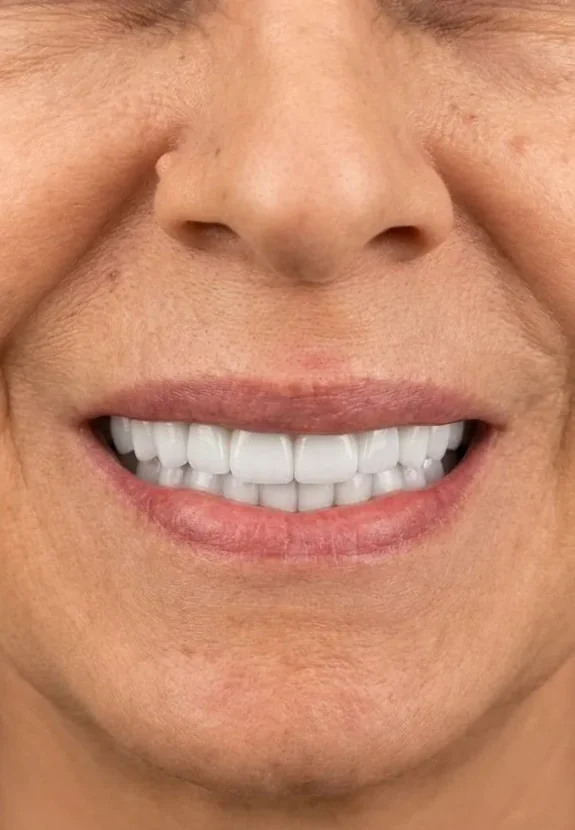 After: Full-Mouth Rehabilitation