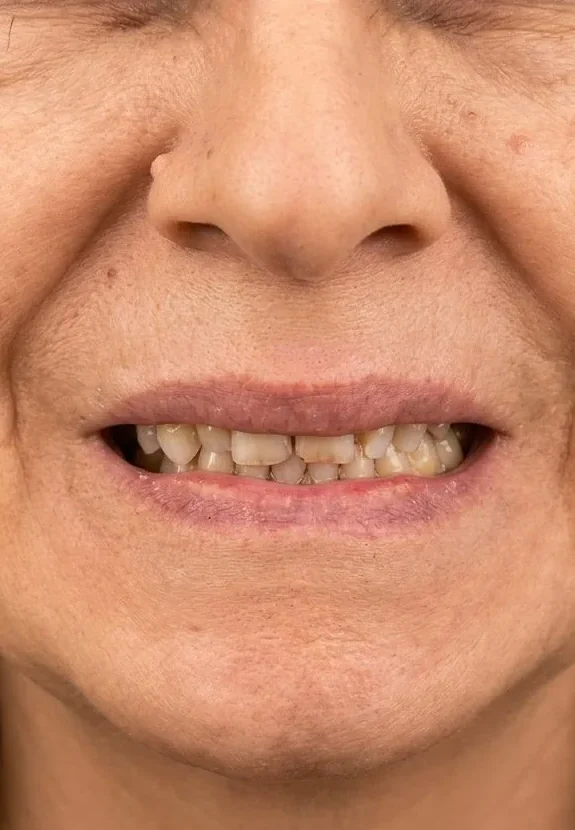 Before: Full-Mouth Rehabilitation