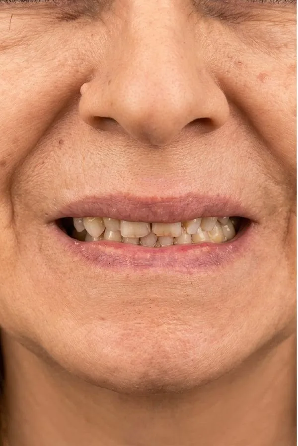 Before: Full-Mouth Rehabilitation