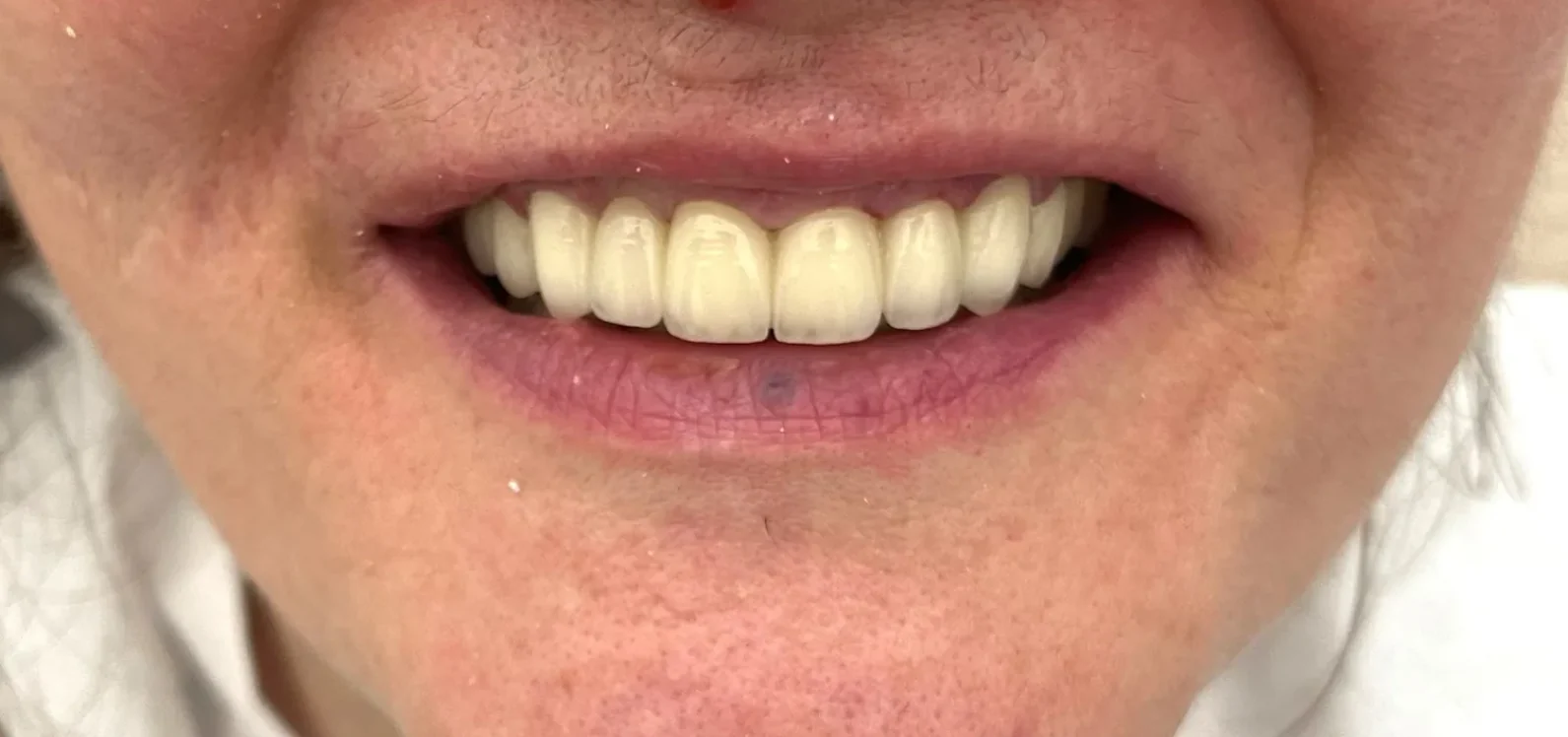 After: Gummy Smile Correction & Smile Rehabilitation