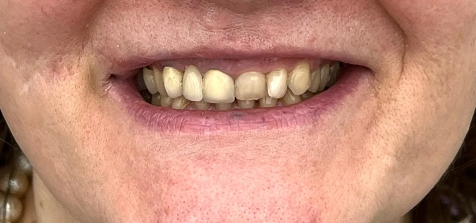 Before: Gummy Smile Correction & Smile Rehabilitation
