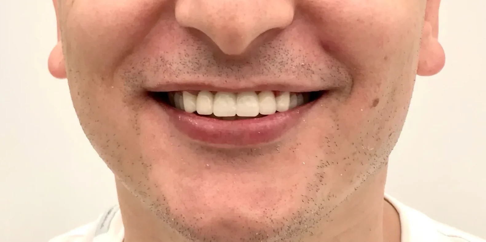 After: Facially Driven Smile Design (Turkey Teeth Recovery)