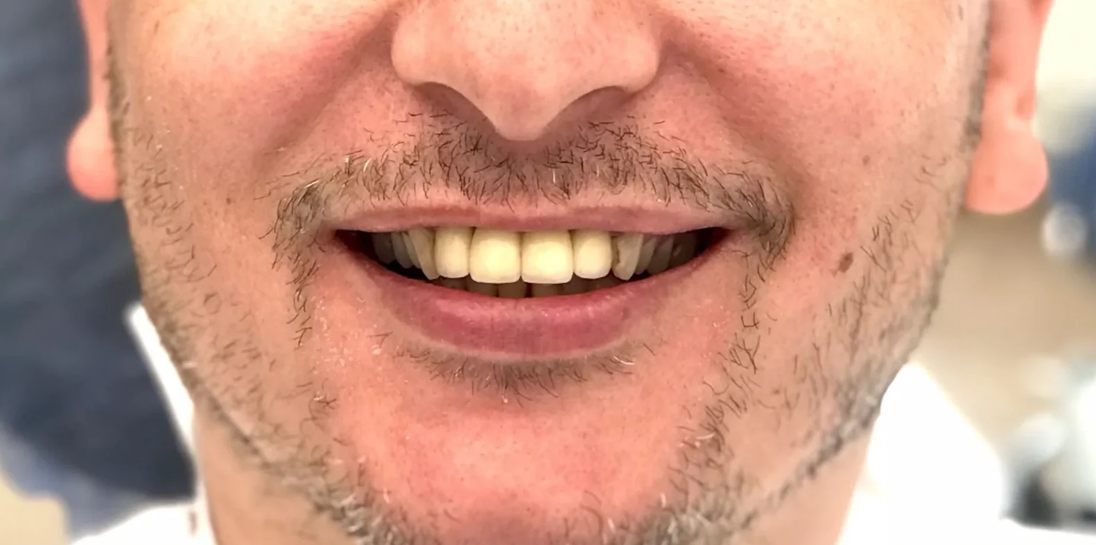 Before: Facially Driven Smile Design (Turkey Teeth Recovery)
