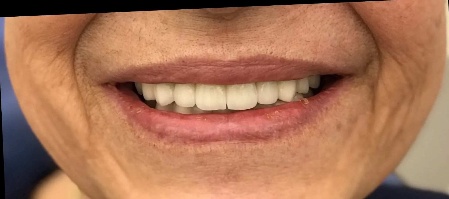 After: Functional smile rehabilitation — real GC Clinic case