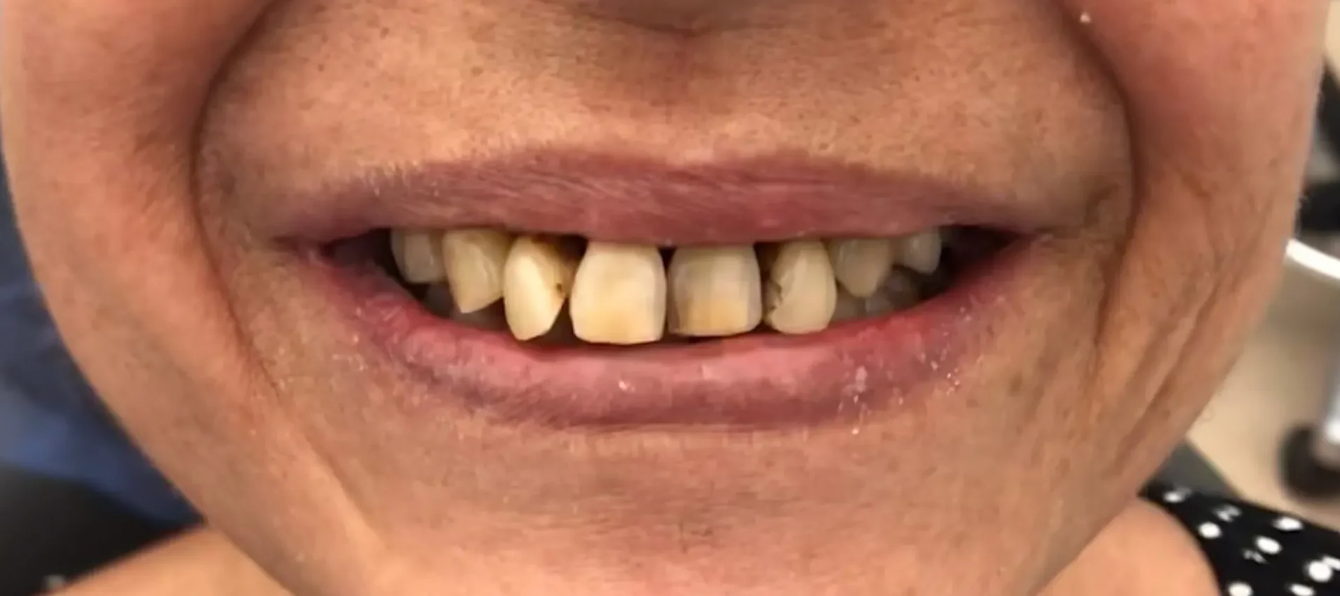 Before: Functional smile rehabilitation — real GC Clinic case