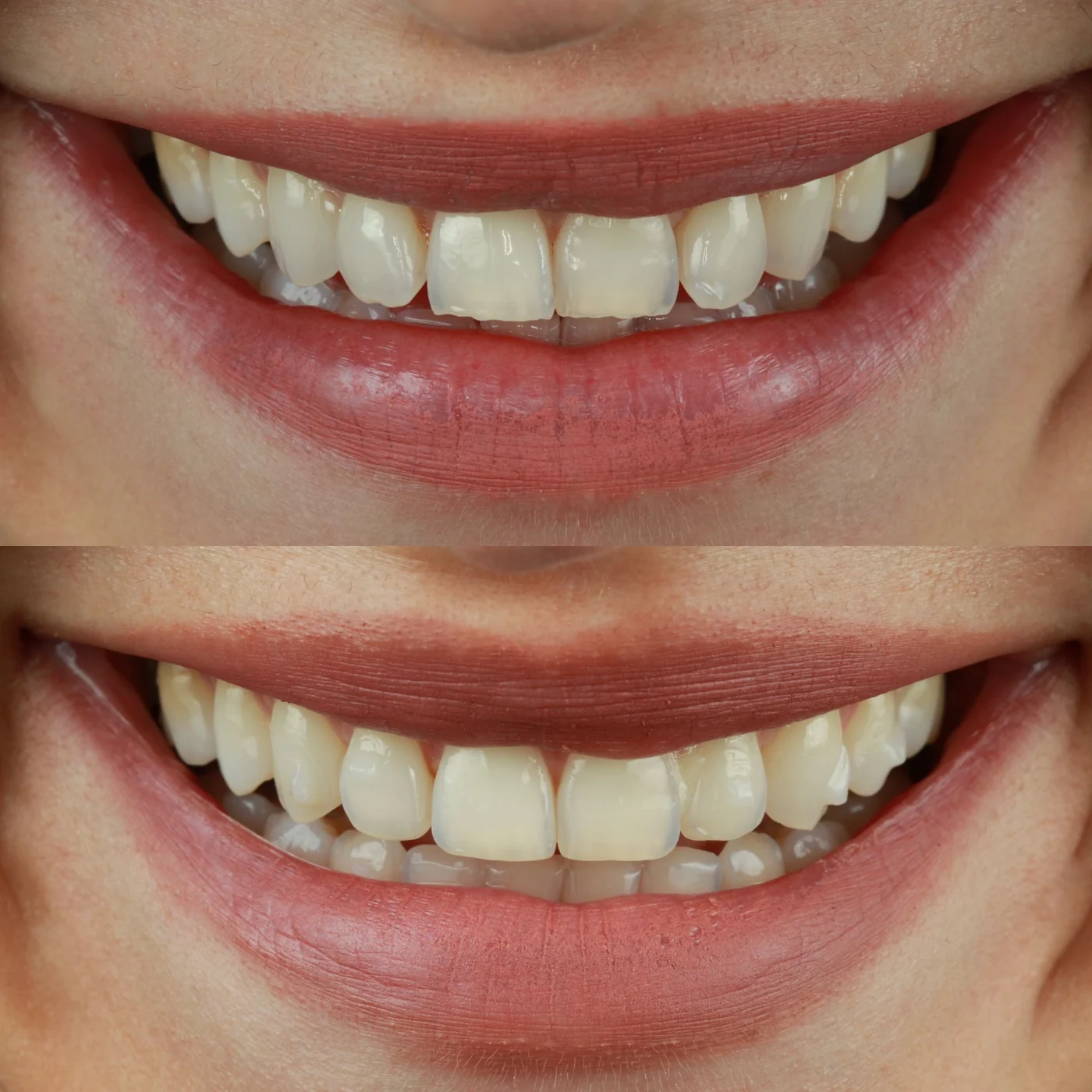 Before and after clear-aligner orthodontics at GC Clinic Istanbul