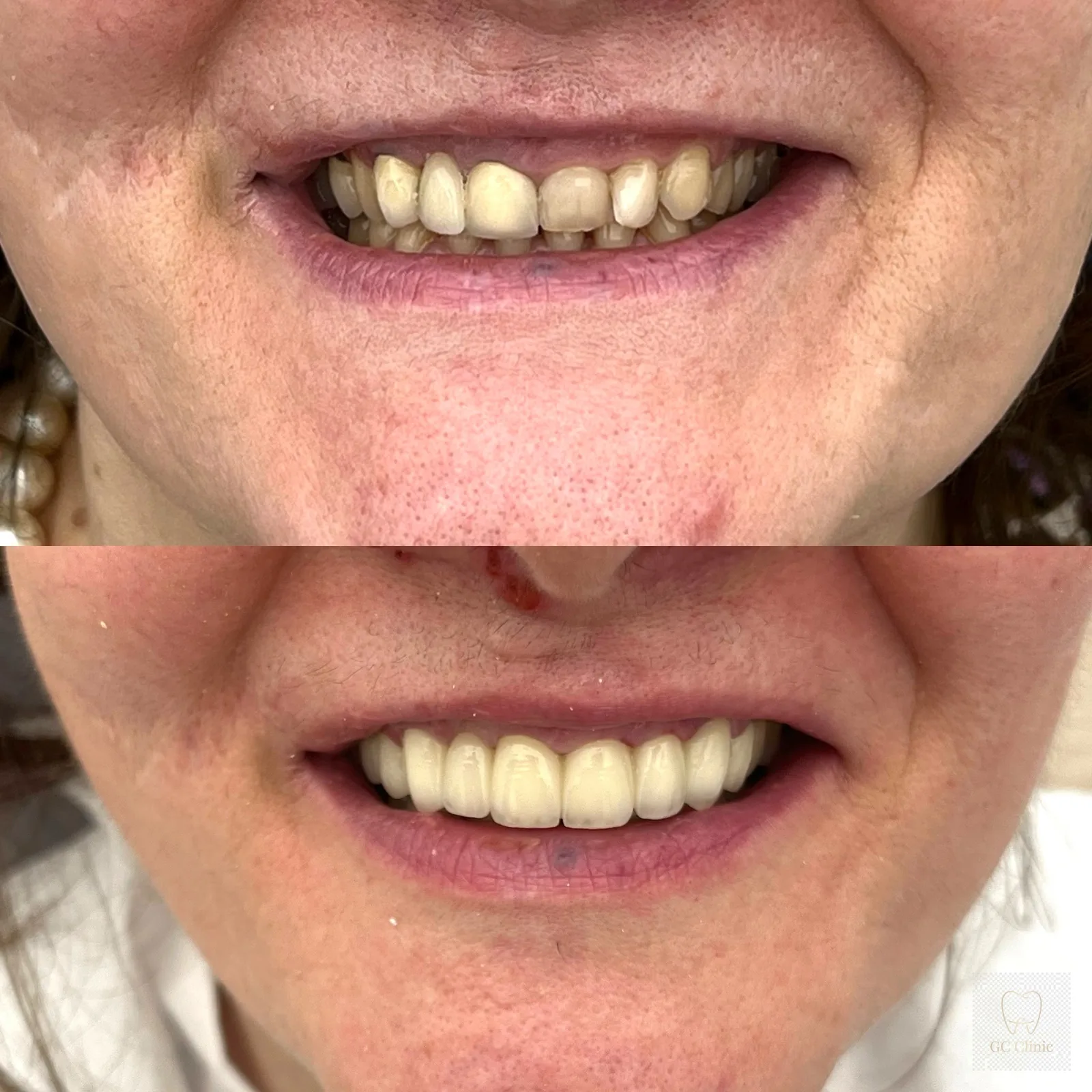 Veneer vs crown illustration