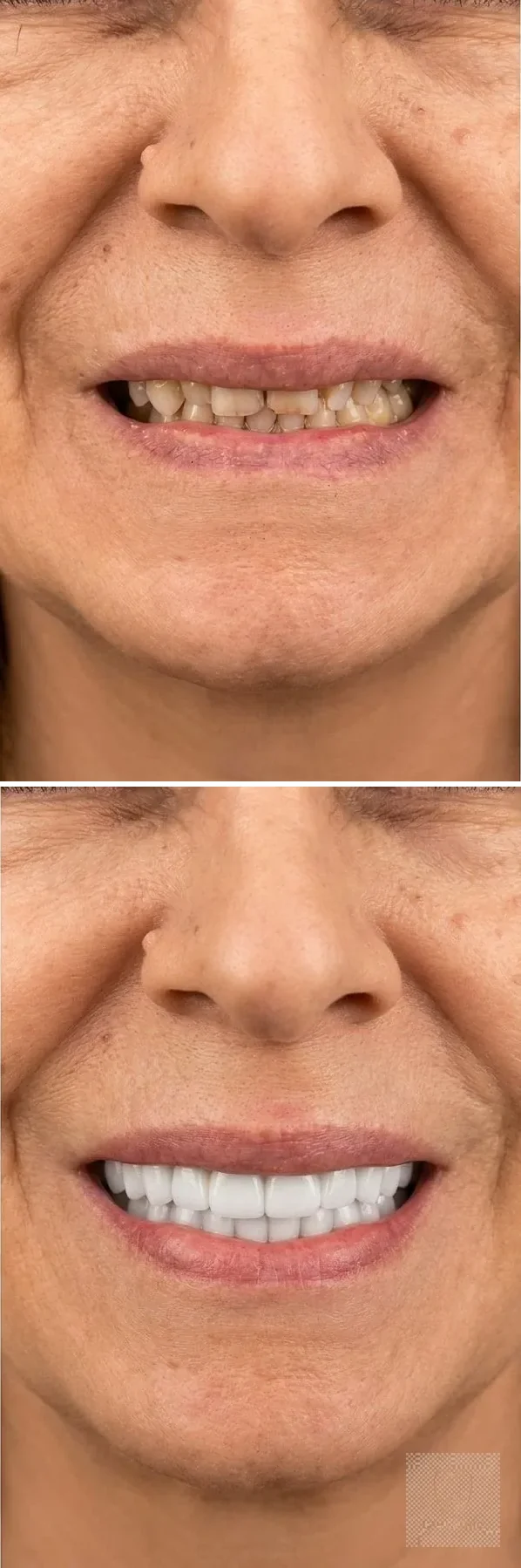 Before and after — full-mouth rehabilitation with Ivoclar layered zirconia, real GC Clinic case (before above, after below)