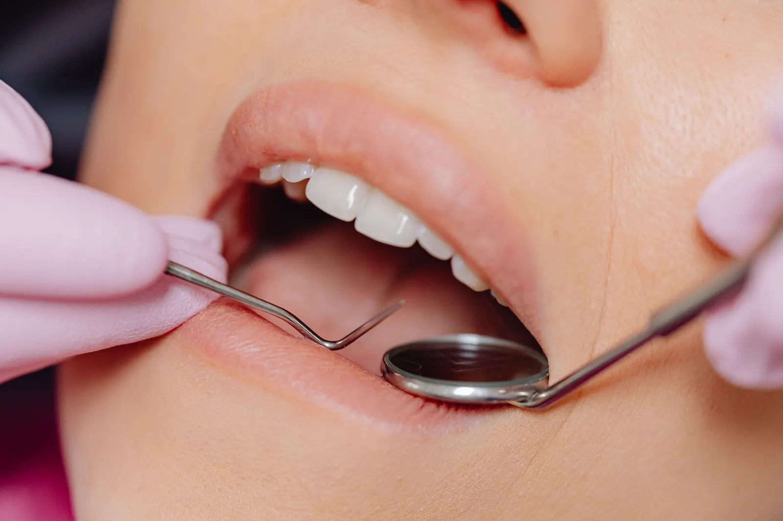 Dark gums treatment — gum melanin pigmentation laser depigmentation