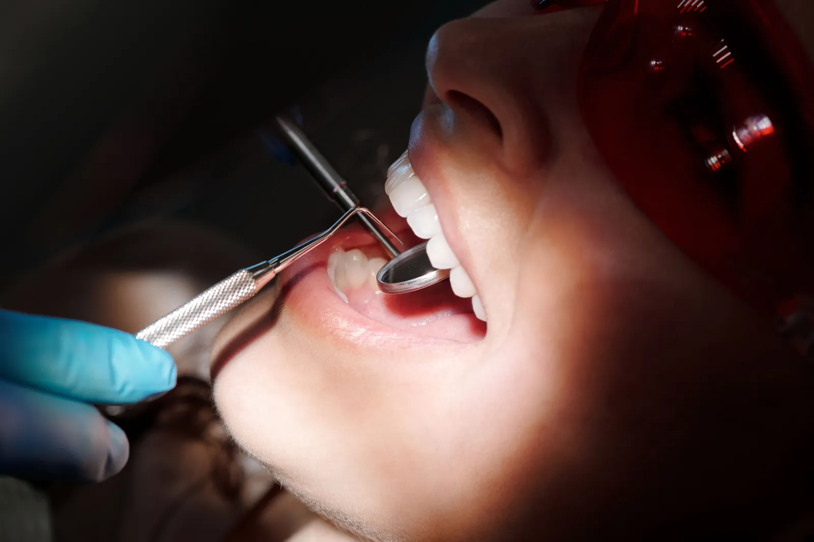 Fractura dental: tipos, diagnóstico y tratamiento