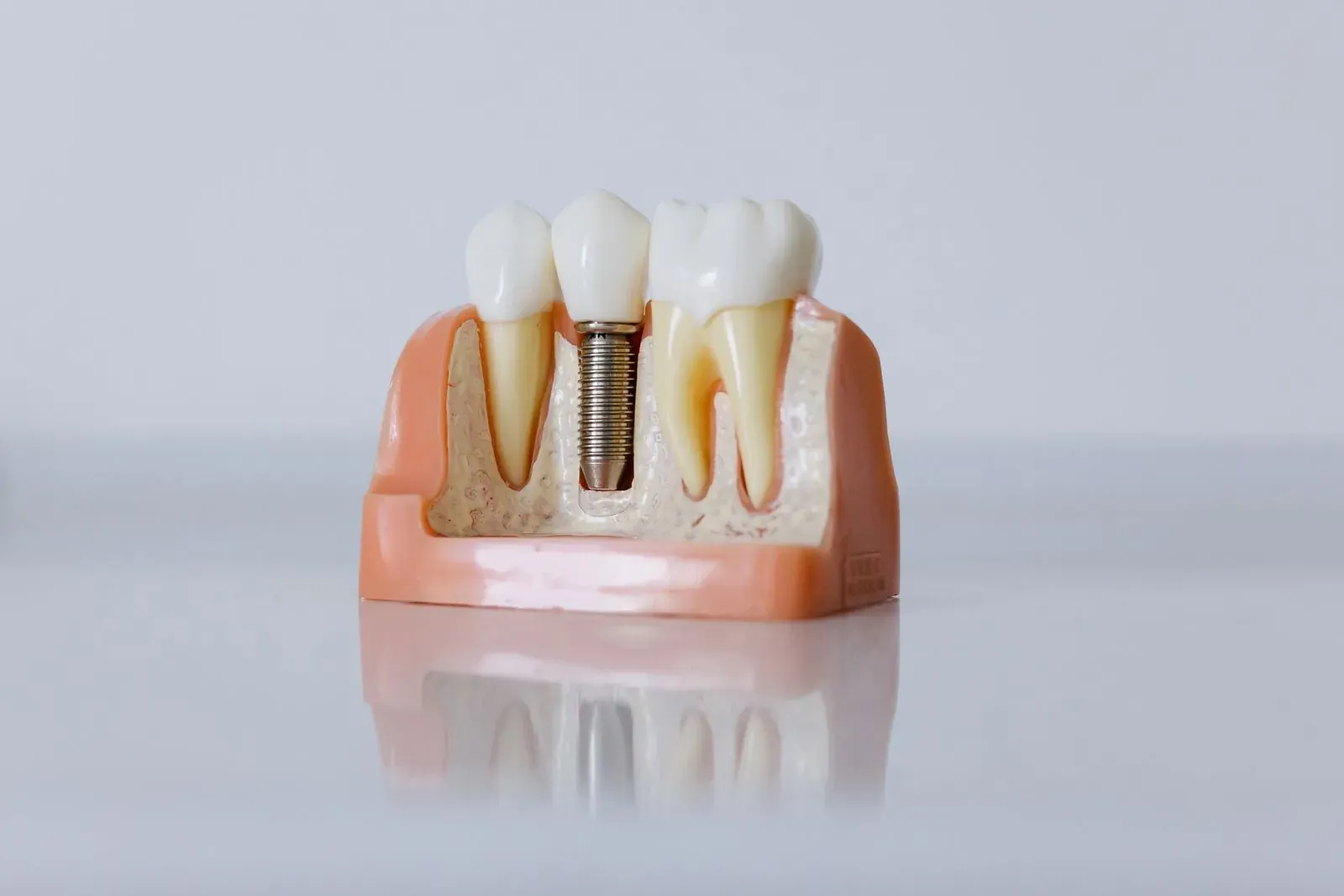 Types d’implants dentaires :Straumann, Nobel, génériques — le guide.