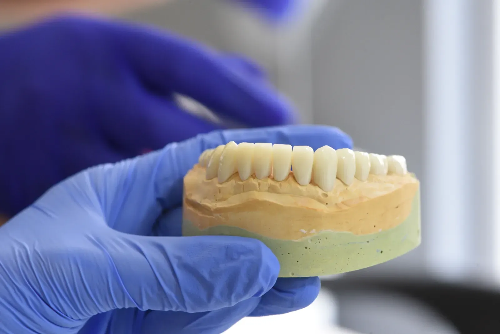 L'Impianto Dentaleper un Sorriso Sano.