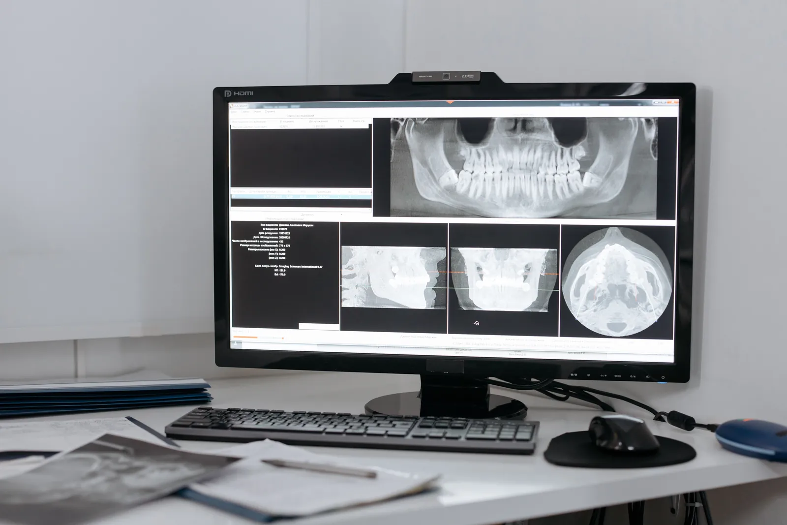 Jaw Cysts: Diagnosis, Surgical Treatment, and What Pathology Tells You