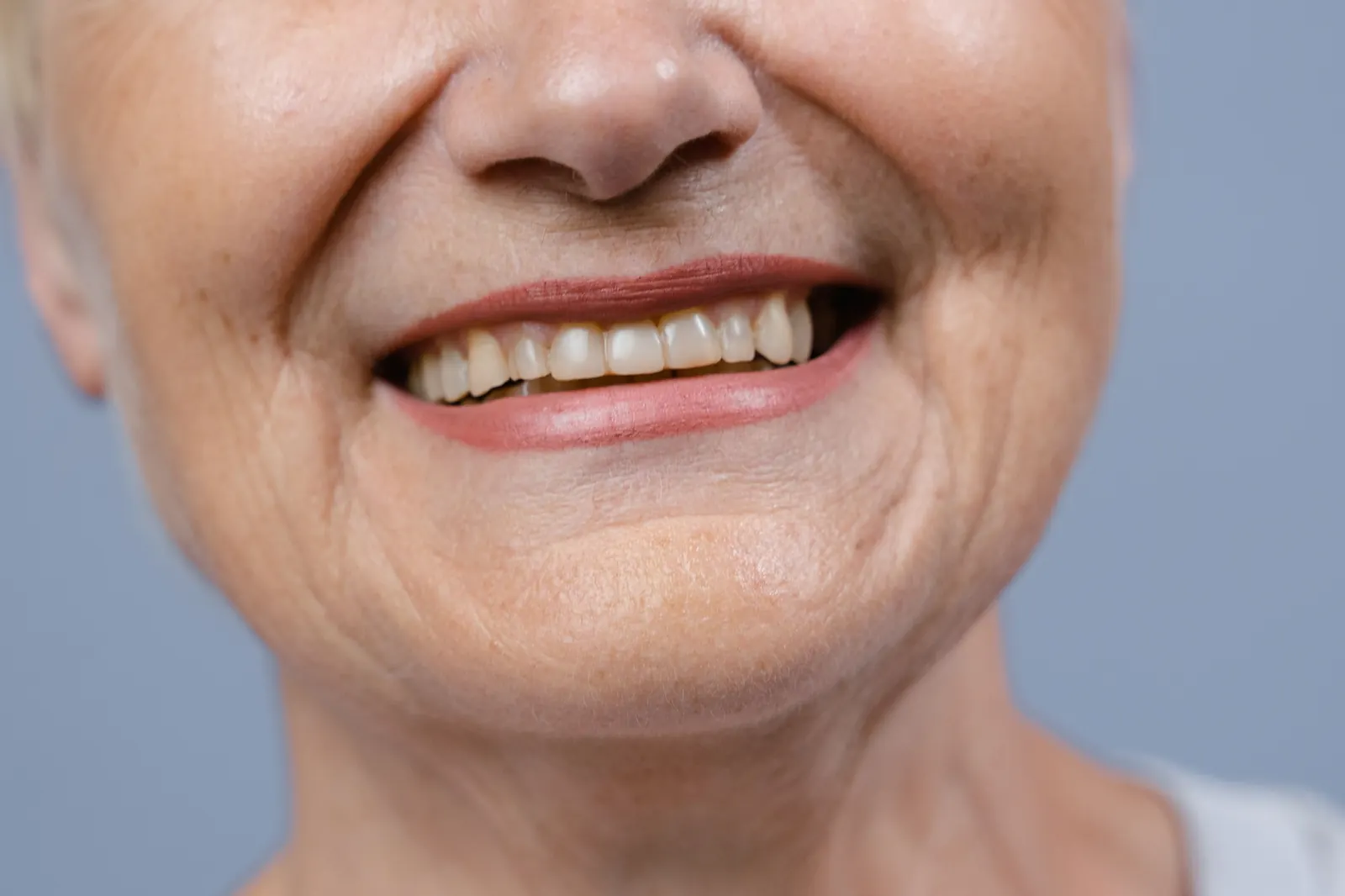 Illustration de l'article sur old money smile facette discrete — GC Clinic Istanbul