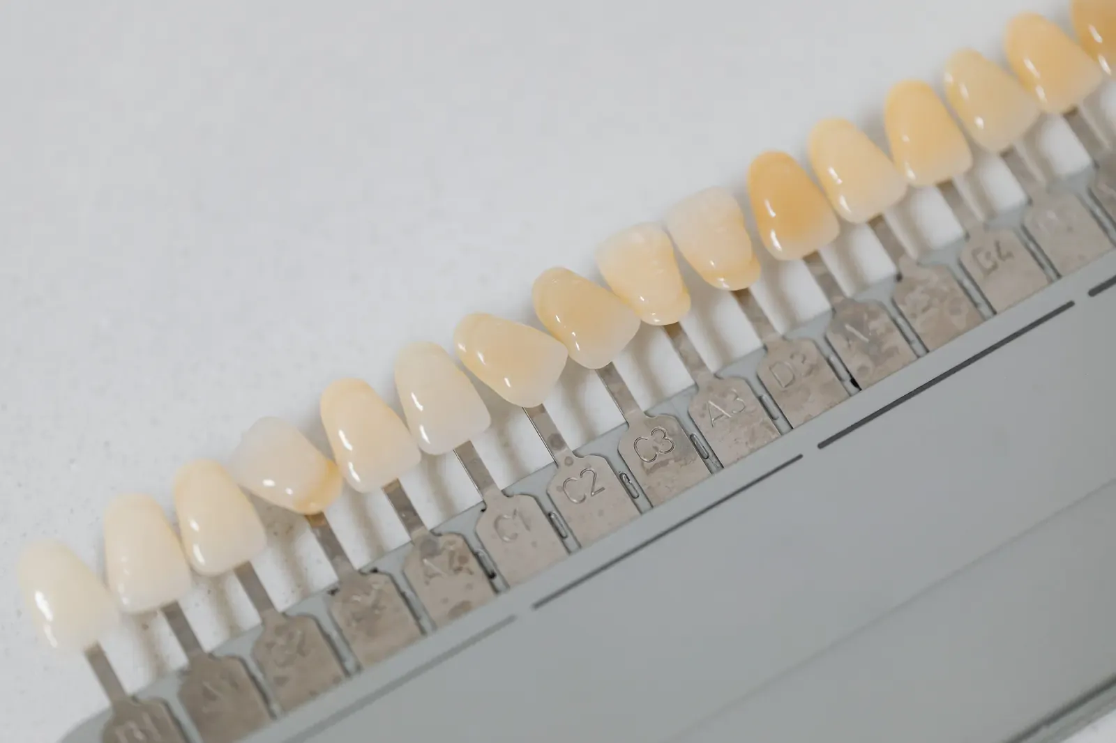 Tandspleet (Diastema) — Sluiten Zonder Overbehandeling